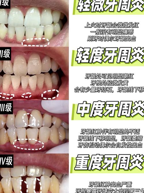 牙周治疗、正畸、修复三者具体有何区别？-图2