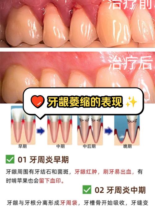 牙周炎没治好就勉强种牙,会有什么后果?-图2 牙周炎没治好就勉强种牙,会有什么后果?-图2