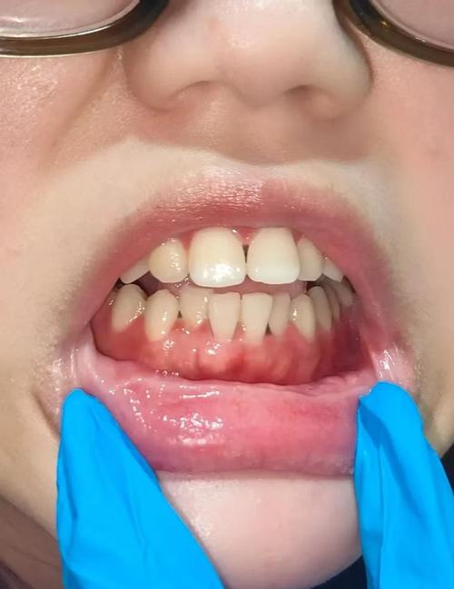 牙周炎没治好就勉强种牙,会有什么后果?-图1 牙周炎没治好就勉强种牙,会有什么后果?-图1