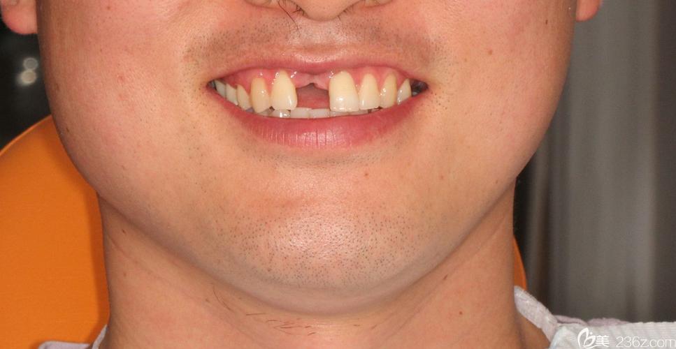 门牙突出适合种牙吗？种植修复能解决问题吗？-图2