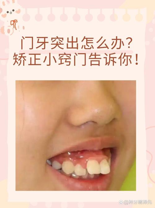 门牙突出适合种牙吗？种植修复能解决问题吗？-图1