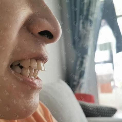 门牙突出适合种牙吗？种植修复能解决问题吗？-图3