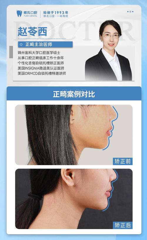 门齿正畸成功案例效果如何?秘诀是什么?-图1 门齿正畸成功案例效果如何?秘诀是什么?-图1