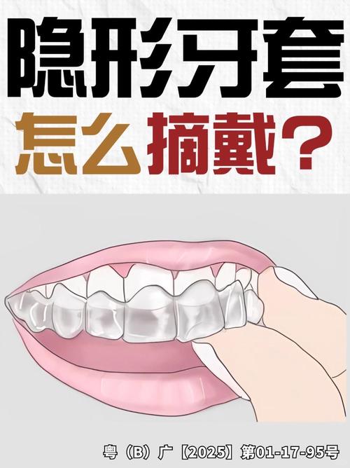如何正确佩戴牙套？新手必学步骤与注意事项-图2