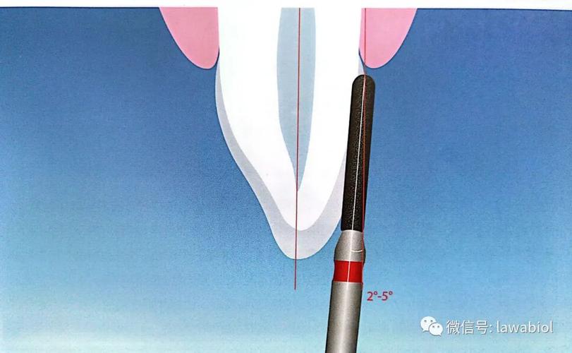 如何精准掌握备牙肩台的操作方法？-图2