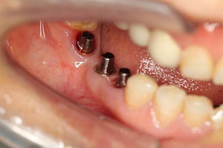 拔牙后种牙，关键步骤有哪些？-图2