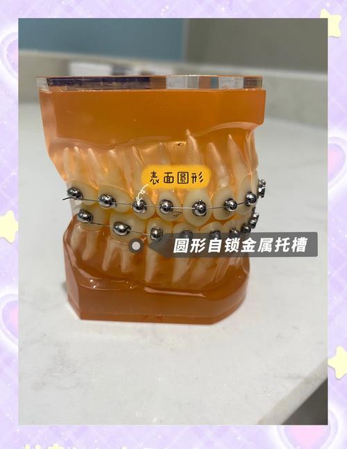 口腔正畸托槽定位模板如何提升矫正精准度?-图3 口腔正畸托槽定位模板如何提升矫正精准度?-图3