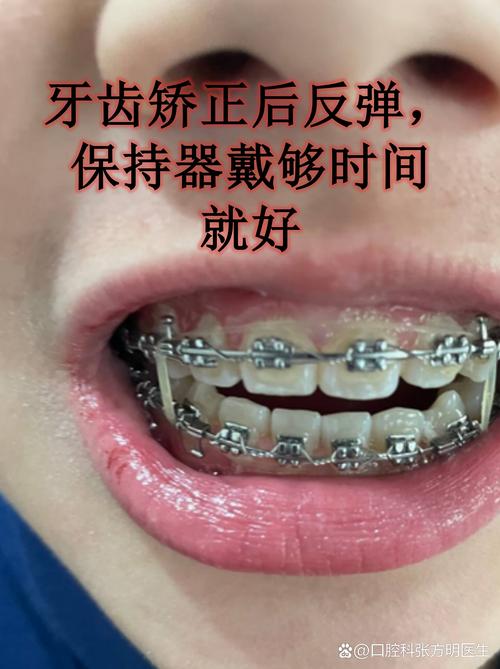 正畸固定矫治，刷牙方法有哪些关键技巧？-图1