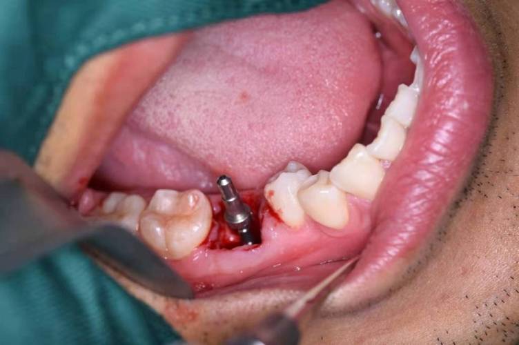 欧洲牙钉种牙效果究竟如何？靠谱吗？-图1