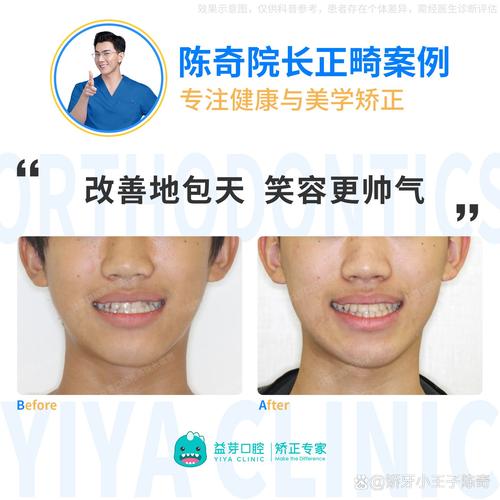 Damon张慧男正畸效果如何？技术优势有哪些？-图3