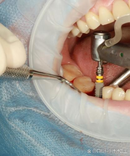 47号牙拔牙种牙-图2