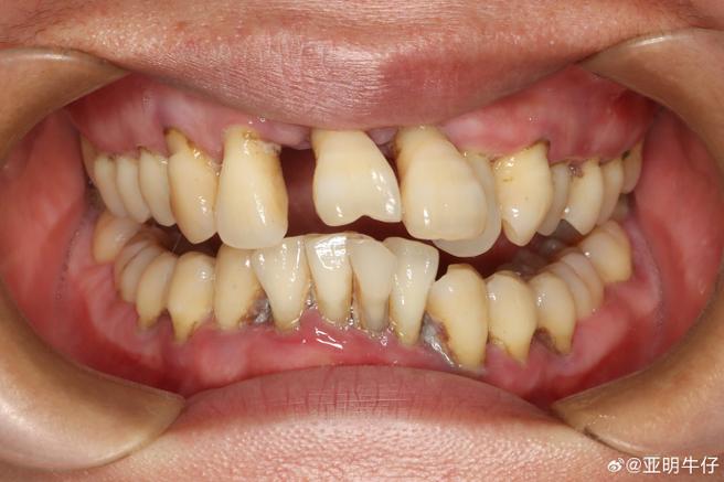 正畸拔牙后牙齿松动，是正常现象吗？如何处理？-图2