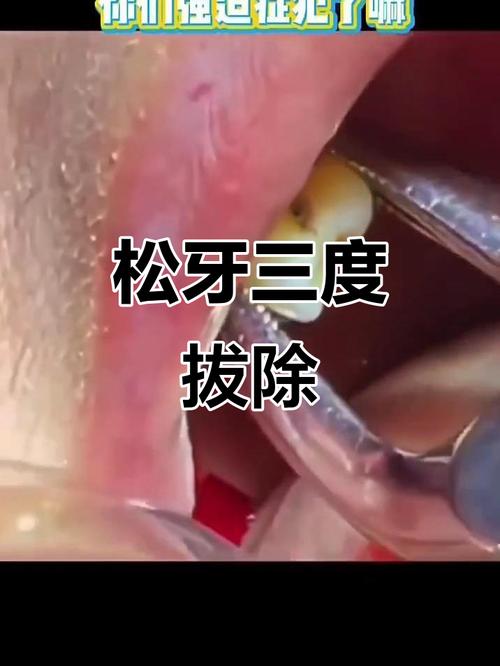 正畸拔牙后牙齿松动，是正常现象吗？如何处理？-图1