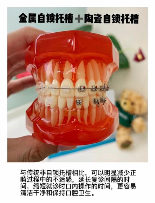 正畸陶瓷托槽还是隐形-图3