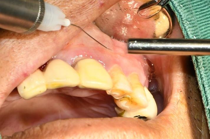 活髓牙麻醉方法有哪些常见选择及适用场景？-图3