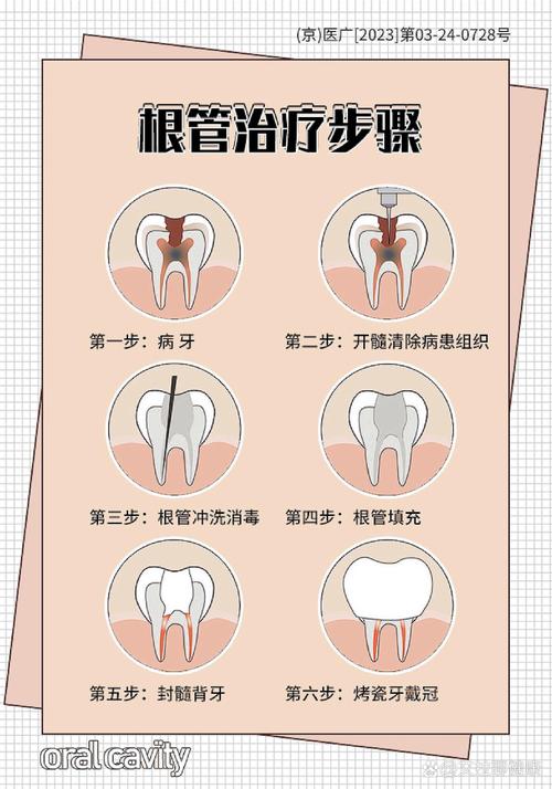 根管换药的具体操作方法及注意事项有哪些?-图2 根管换药的具体操作方法及注意事项有哪些?-图2
