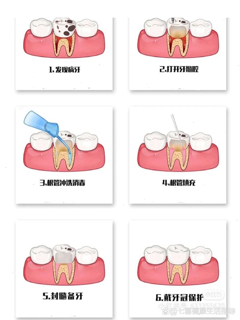 根管换药的具体操作方法及注意事项有哪些?-图3 根管换药的具体操作方法及注意事项有哪些?-图3