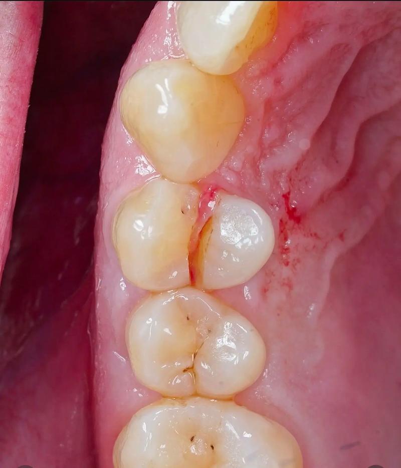 种牙时用自身牙齿有哪些技术优势?-图2 种牙时用自身牙齿有哪些技术优势?-图2