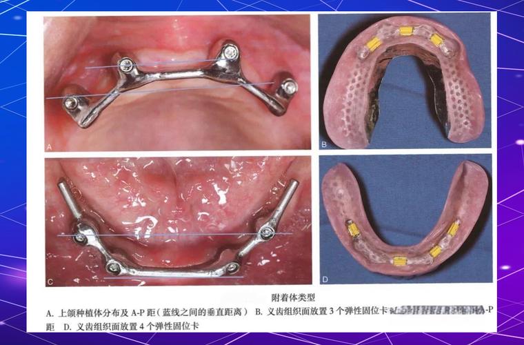 cortex种牙效果好不好？适合哪些情况？-图1