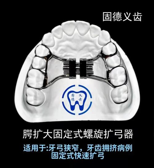 牙科扩弓的常用方法有哪些？-图3