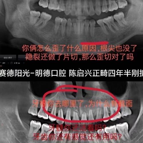 正畸致牙根吸收，患者起诉能获赔偿吗？-图2