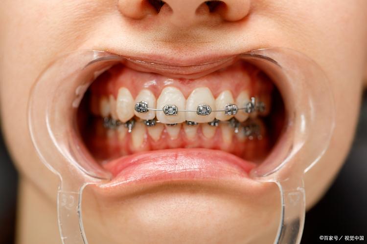 缺牙致牙齿倾斜，正畸矫正如何有效改善？-图2