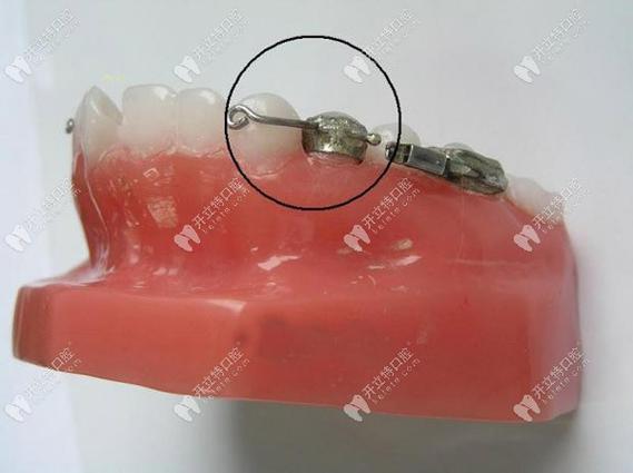 如何科学选择正畸带环的合适大小？-图3