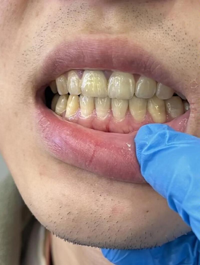 刚种完牙能吸烟吗？会对种植体恢复有影响吗？-图3