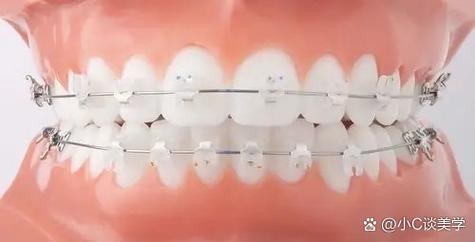 正畸陶瓷托槽彩色标志如何提升正畸精准度与美观度？-图1