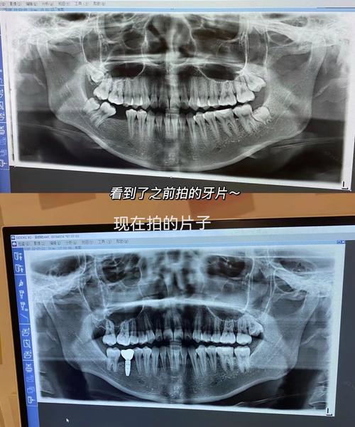 怀孕做牙齿正畸，X光检查对胎儿有影响吗？-图2