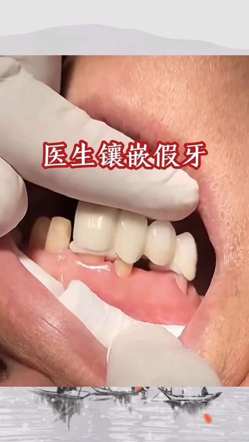 镶牙有哪些常用方法？哪种更适合自己？-图3