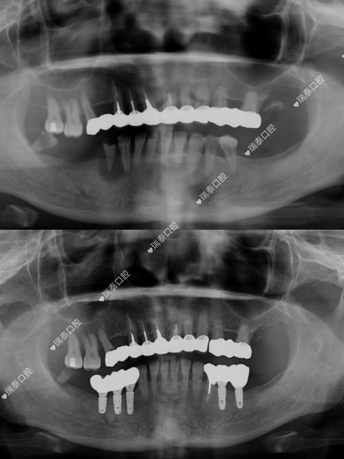 种牙前必须拍CT吗？这些检查到底有啥用？-图3