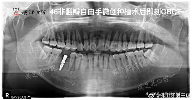 种牙前必须拍CT吗？这些检查到底有啥用？-图1