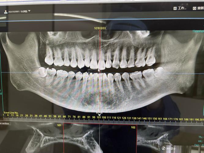 种牙前必须拍CT吗？这些检查到底有啥用？-图2
