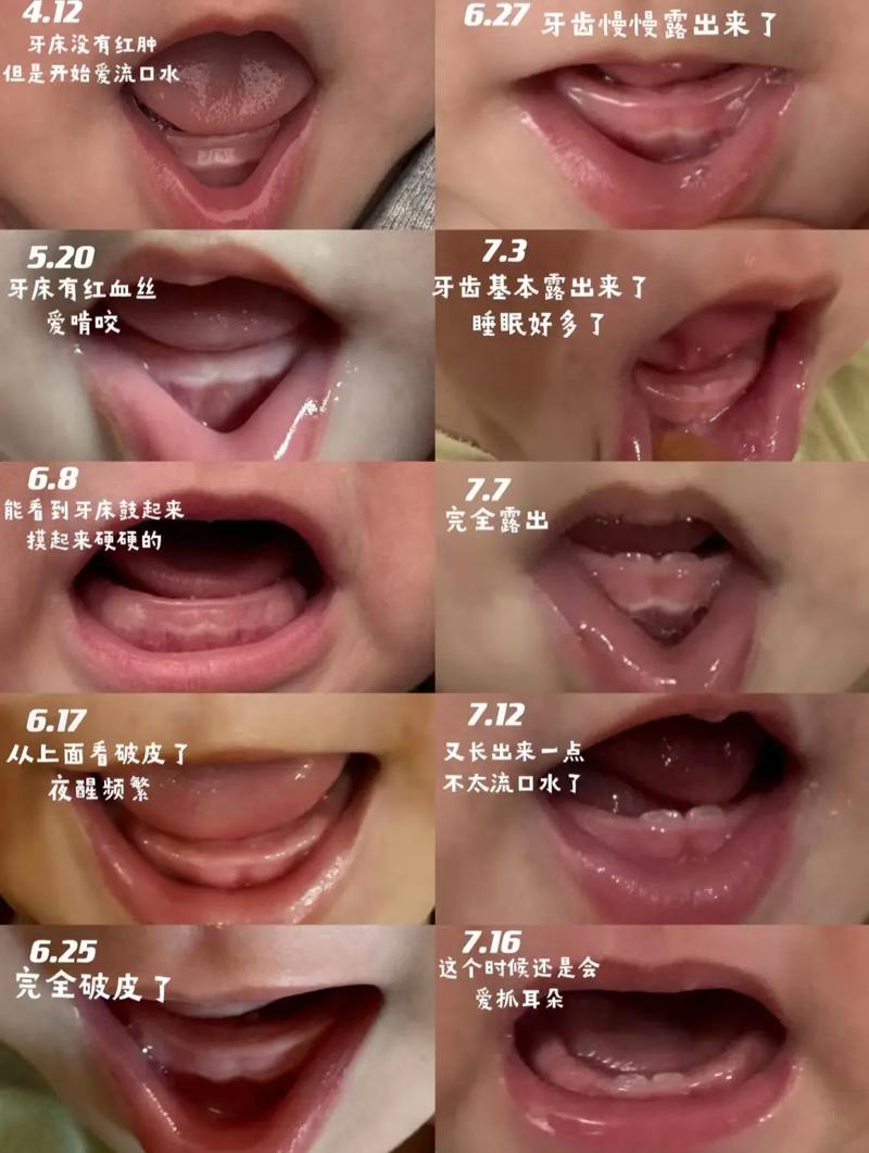 种植牙后，牙齿一般需要多久才能完全长出来？-图3