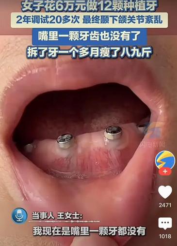 拔牙后为何等一年再种牙？最佳时机有讲究吗？-图2