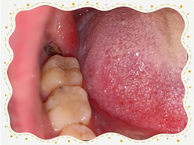 拔牙后为何等一年再种牙？最佳时机有讲究吗？-图3