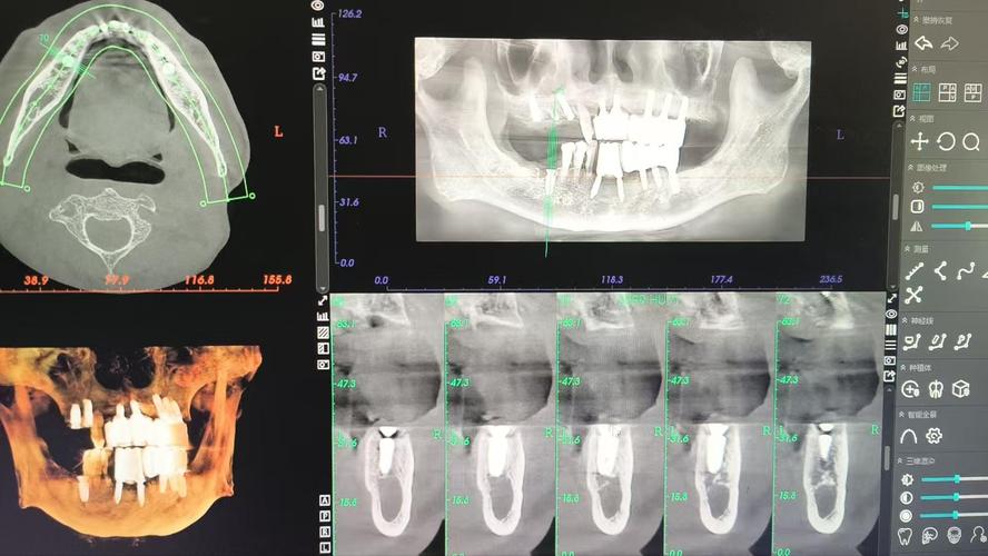 种牙后能做CT检查吗？术后多久可行？-图3