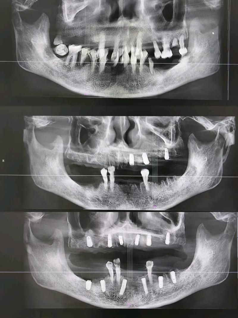 种牙后能做CT检查吗？术后多久可行？-图1