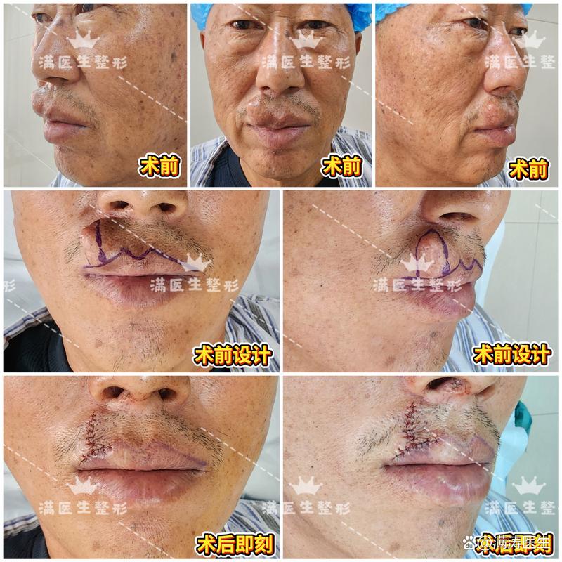 上唇短矫正手术方法有哪些具体类型推荐？-图3