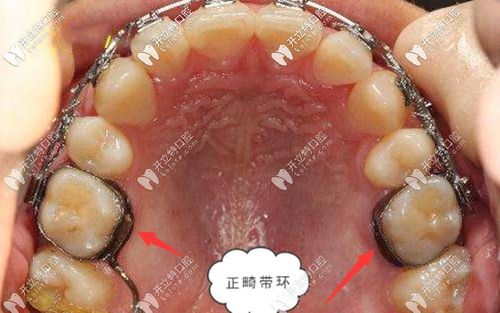 口腔正畸带环焊接视频，操作技巧与注意事项有哪些？-图2