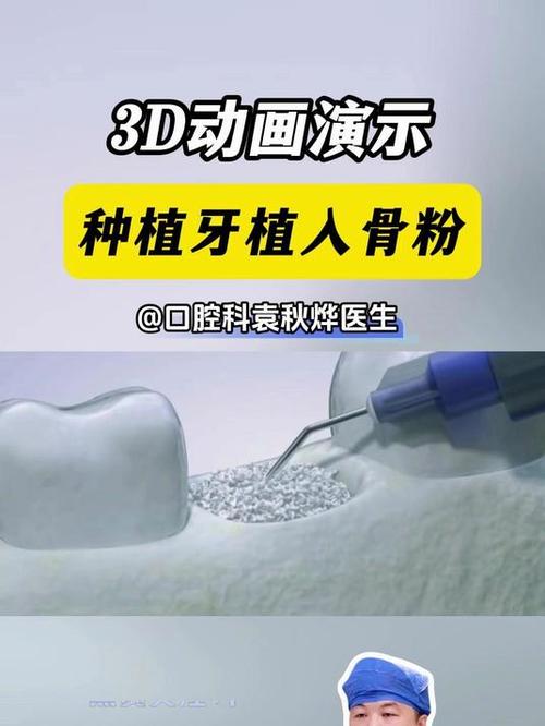 植骨粉种牙安全吗？风险与安全如何兼顾？-图3