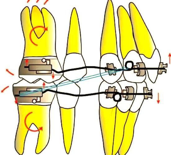 正畸怎么抬高后牙高度？具体方法有哪些？-图3
