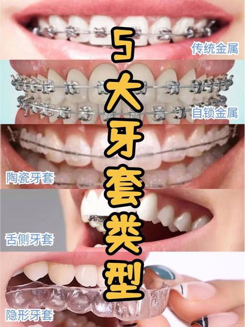 广州番禺正畸牙齿纠正，效果和价格怎么样？-图2