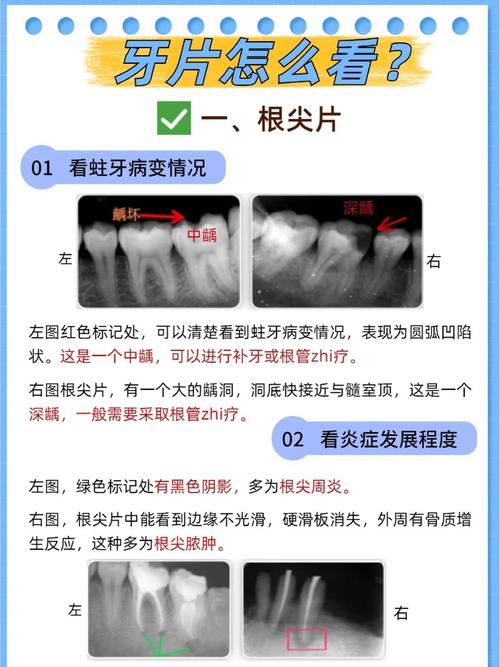 口腔拍片常用方法有哪些?各自适用什么情况?-图3 口腔拍片常用方法有哪些?各自适用什么情况?-图3