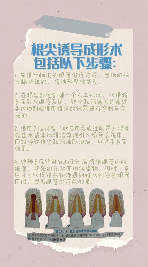 根尖诱导术的常用方法有哪些？各自适用情况如何？-图2