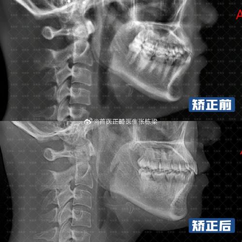 正畸后上颌中线不齐，为何会出现这种情况？-图2