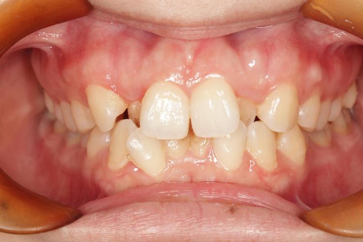 正畸后上颌中线不齐，为何会出现这种情况？-图1