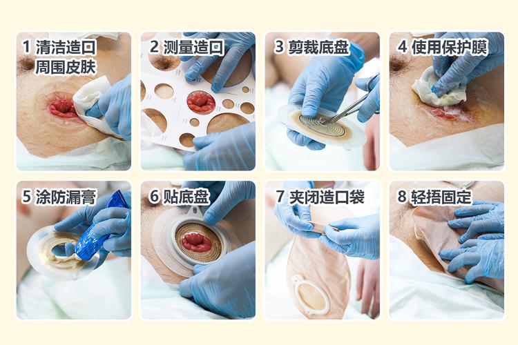 口腔引流常用方法有哪些？如何正确操作？-图2