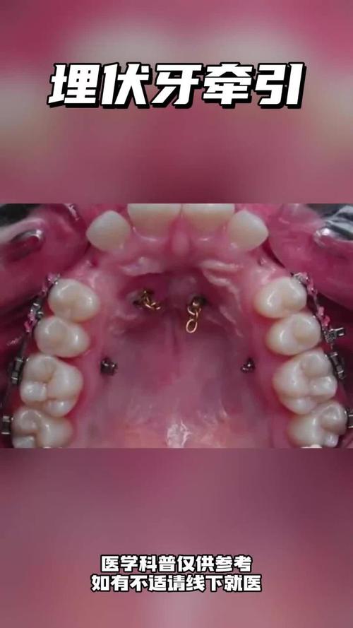 牙齿牵引的方法-图2